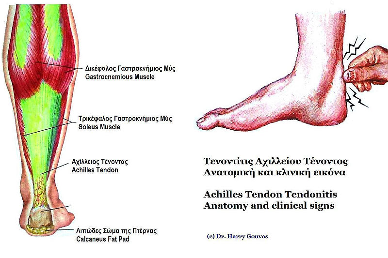 Achillies Tendonitis