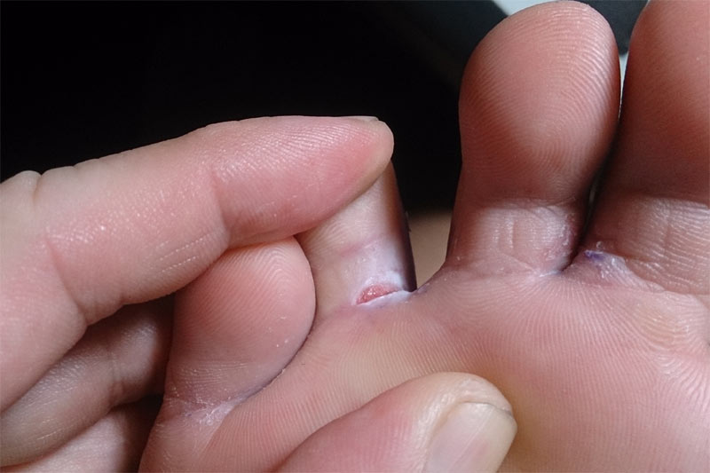 Athlete's Foot