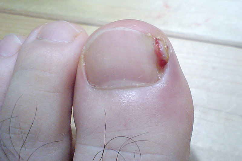 Ingrown toenails