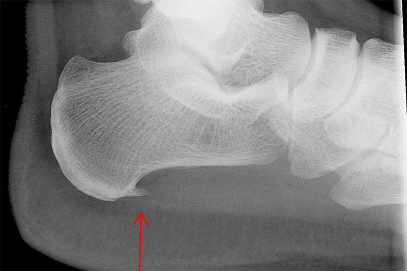 Plantar fasciitis